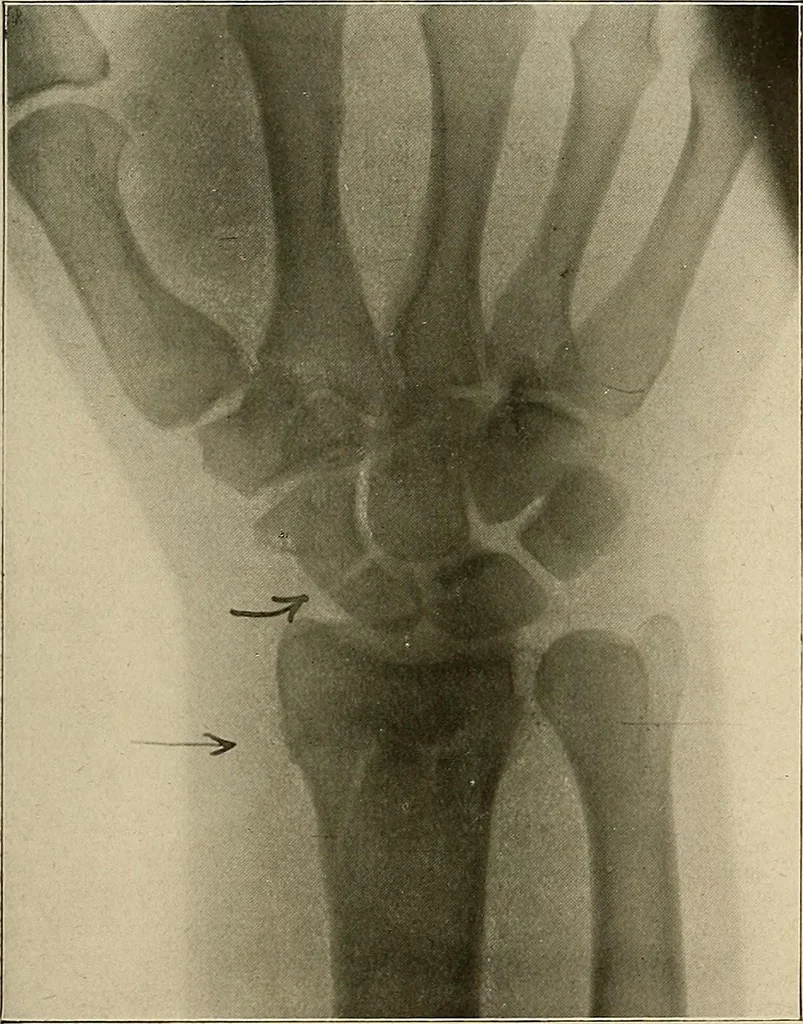 An illustration from A text-book of radiology, 1915, leaf 170