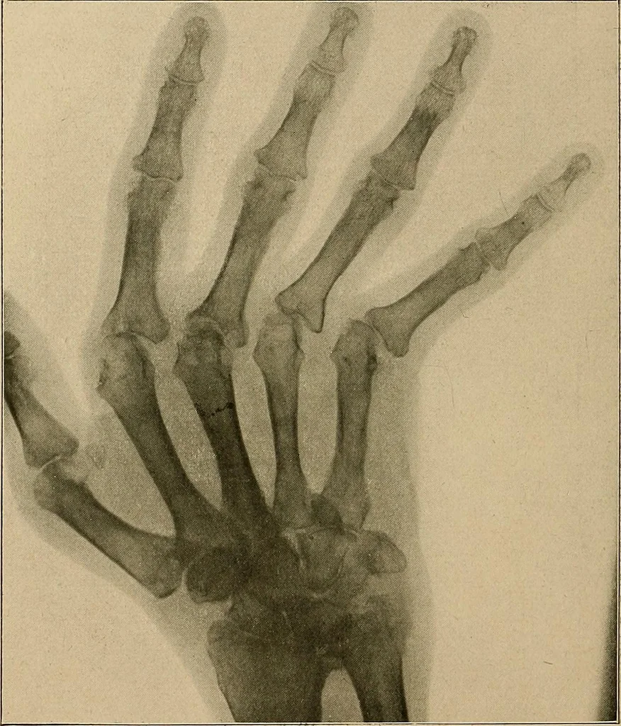 An illustration from A text-book of radiology, 1915, leaf 171