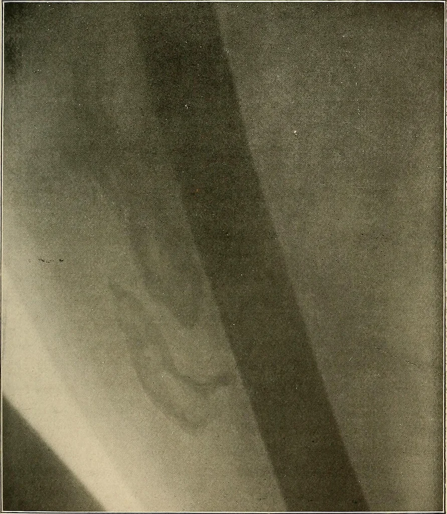 An illustration from A text-book of radiology, 1915, leaf 172