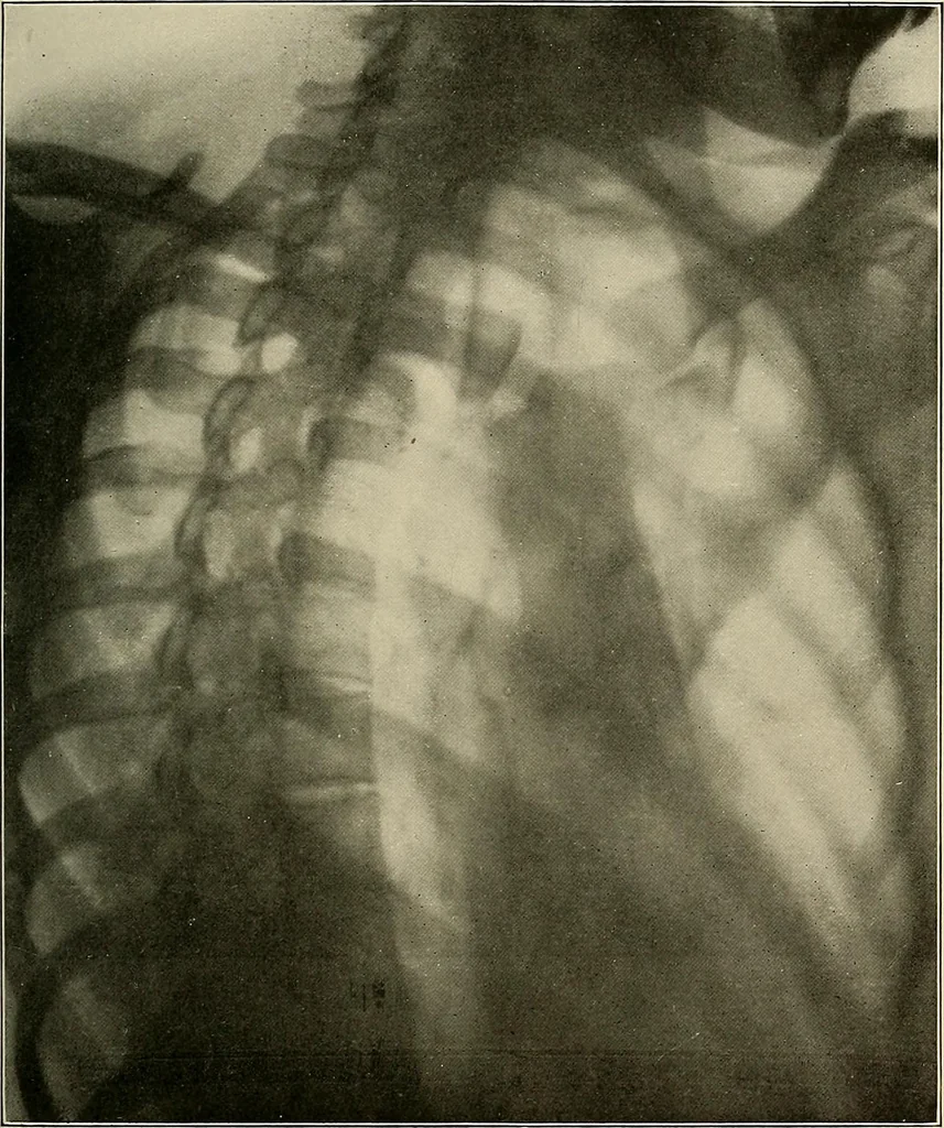 An illustration from A text-book of radiology, 1915, leaf 190