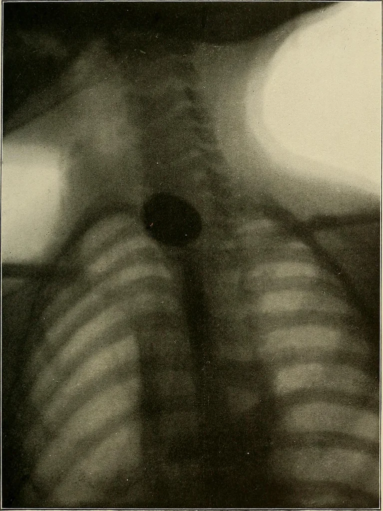 An illustration from A text-book of radiology, 1915, leaf 200