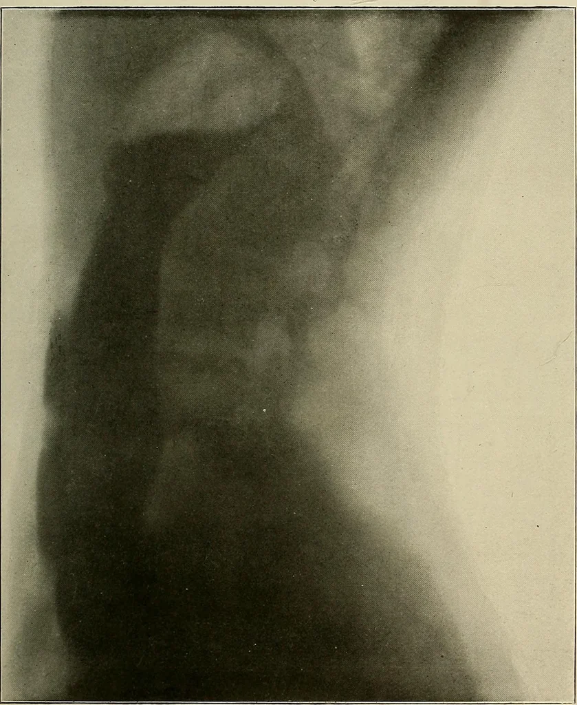 An illustration from A text-book of radiology, 1915, leaf 222