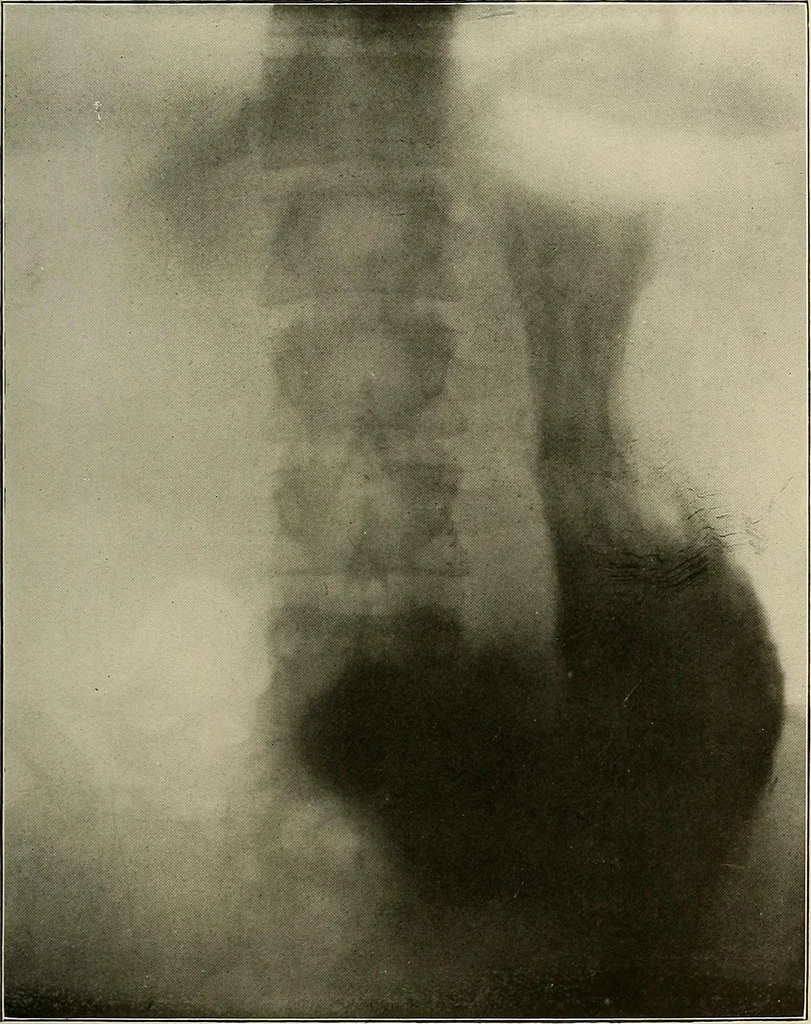 An illustration from A text-book of radiology, 1915, leaf 224