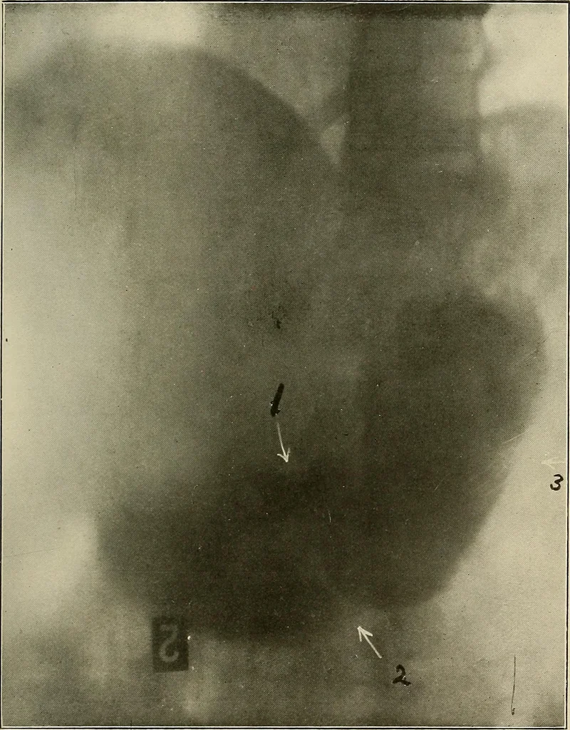 An illustration from A text-book of radiology, 1915, leaf 226