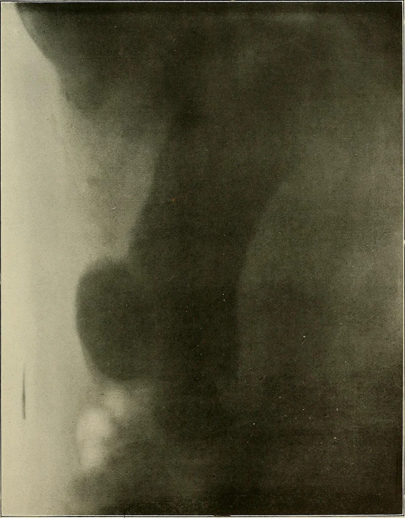 An illustration from A text-book of radiology, 1915, leaf 228