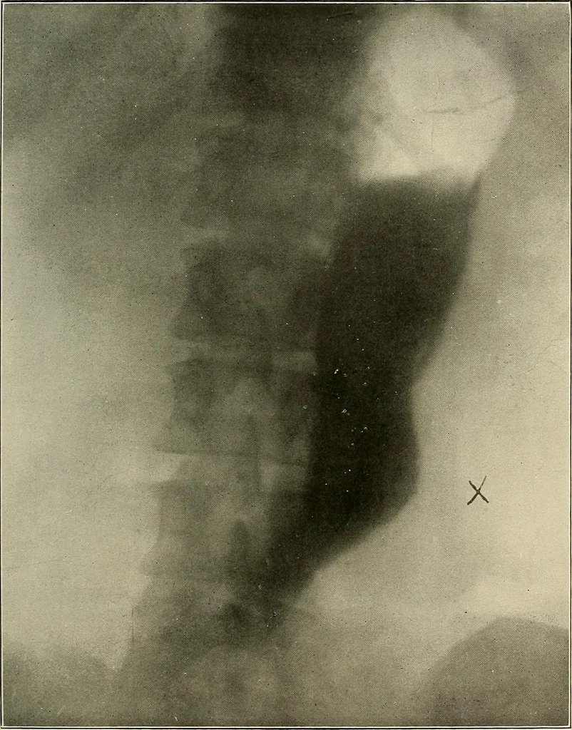 An illustration from A text-book of radiology, 1915, leaf 232