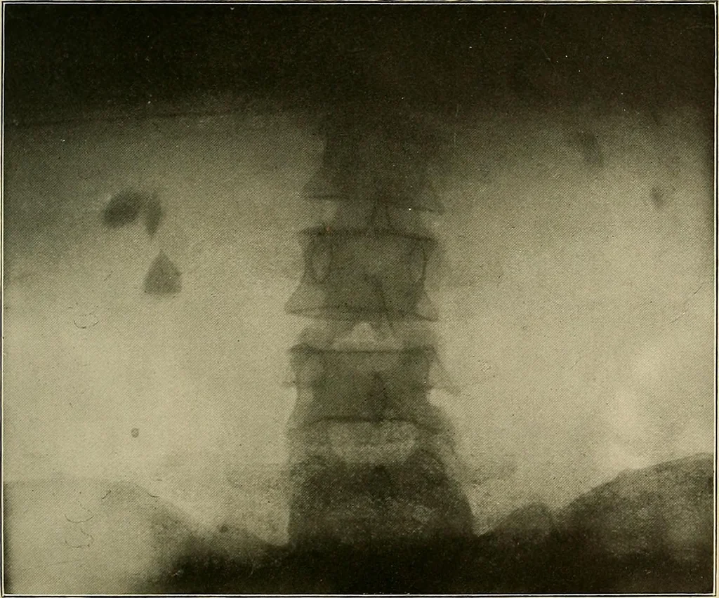 An illustration from A text-book of radiology, 1915, leaf 252
