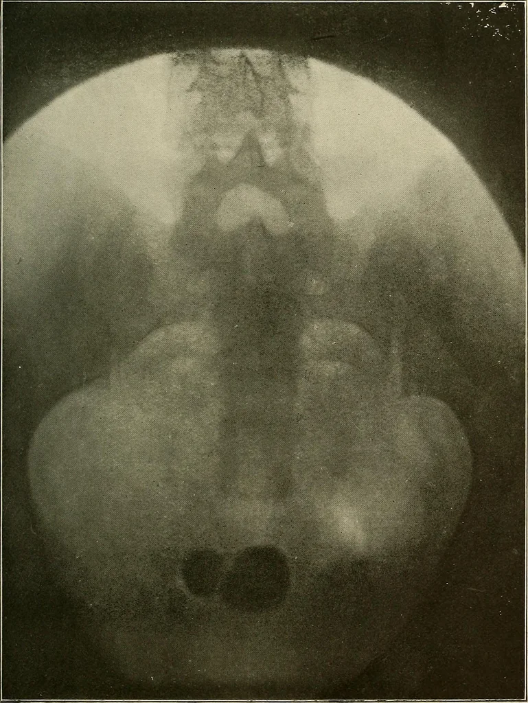 An illustration from A text-book of radiology, 1915, leaf 256