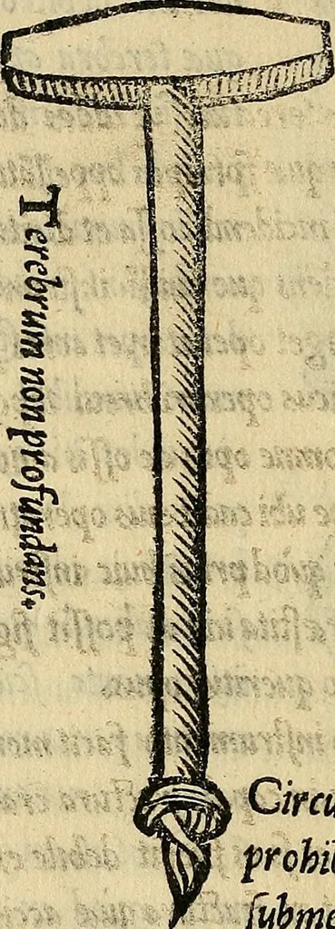 An illustration from Tractatus perutilis et completus de fractura cranei, 1535, leaf 197