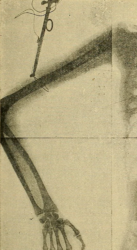 An illustration from Traité de radiographie médicale et scientifique : cours libre professé a l'écolepratique de la Faculté de Médecine de Paris, deuxième semestre de 1896-1897, 1897, leaf 286