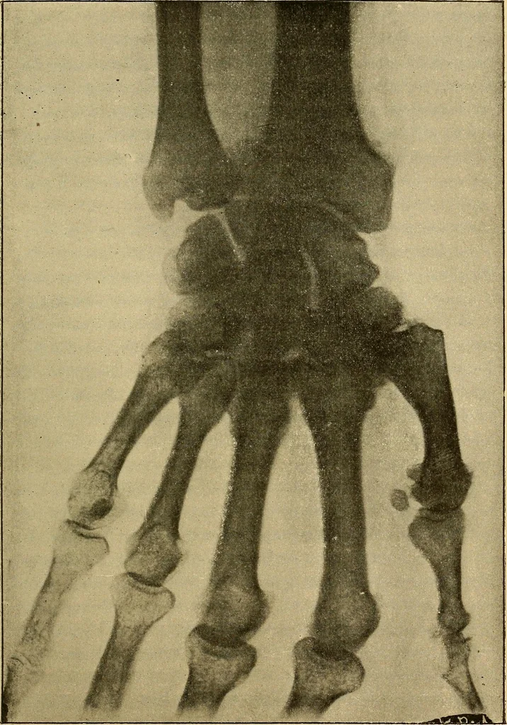 An illustration from Traité de radiographie médicale et scientifique : cours libre professé a l'écolepratique de la Faculté de Médecine de Paris, deuxième semestre de 1896-1897, 1897, leaf 362