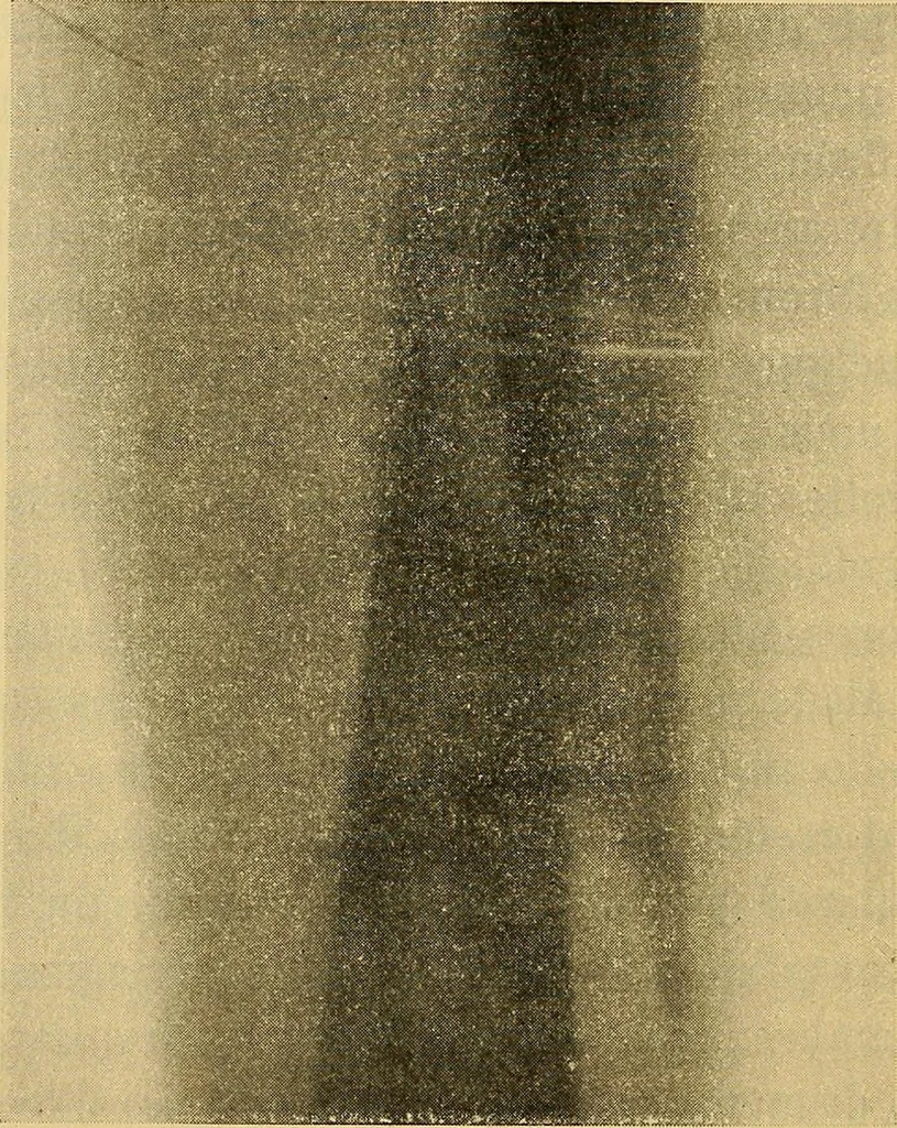 An illustration from Traité de radiographie médicale et scientifique : cours libre professé a l'écolepratique de la Faculté de Médecine de Paris, deuxième semestre de 1896-1897, 1897, leaf 367