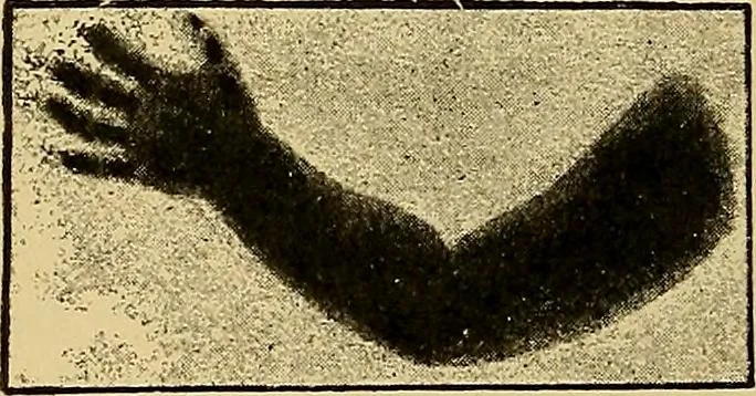 An illustration from Traité de radiographie médicale et scientifique : cours libre professé a l'écolepratique de la Faculté de Médecine de Paris, deuxième semestre de 1896-1897, 1897, leaf 373