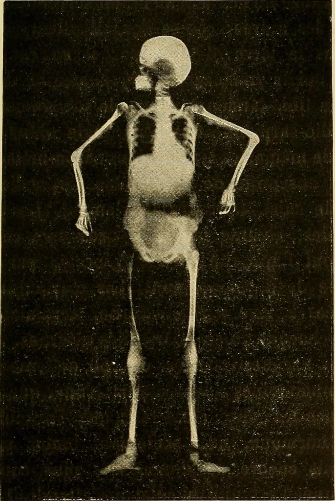 An illustration from Traité de radiographie médicale et scientifique : cours libre professé a l'écolepratique de la Faculté de Médecine de Paris, deuxième semestre de 1896-1897, 1897, leaf 424