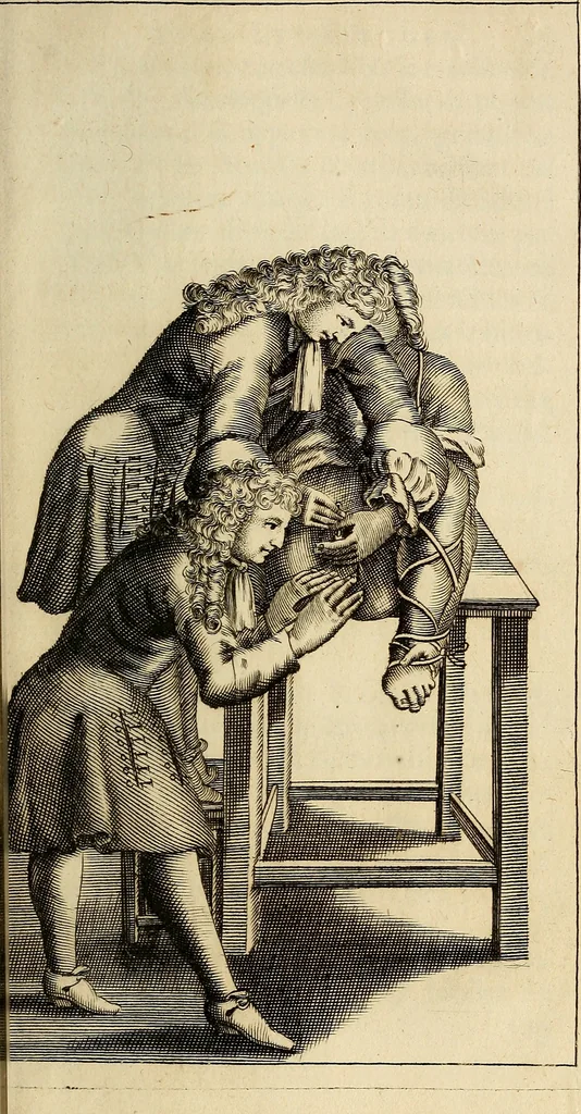 An illustration from Traite' de la lithotomie, ou, De l'extraction de la pierre, hors de la vessie : enrichy de figures necessaires pour representer la maniére de sonder, les instrumens propres, le malade dans l'operation : la ponction du perinée, & les differentes methodes de tirer la pierre : avec les appareils, les remedes preservatifs du calcul, & les medicamens pour les taillez, 1686, leaf 124