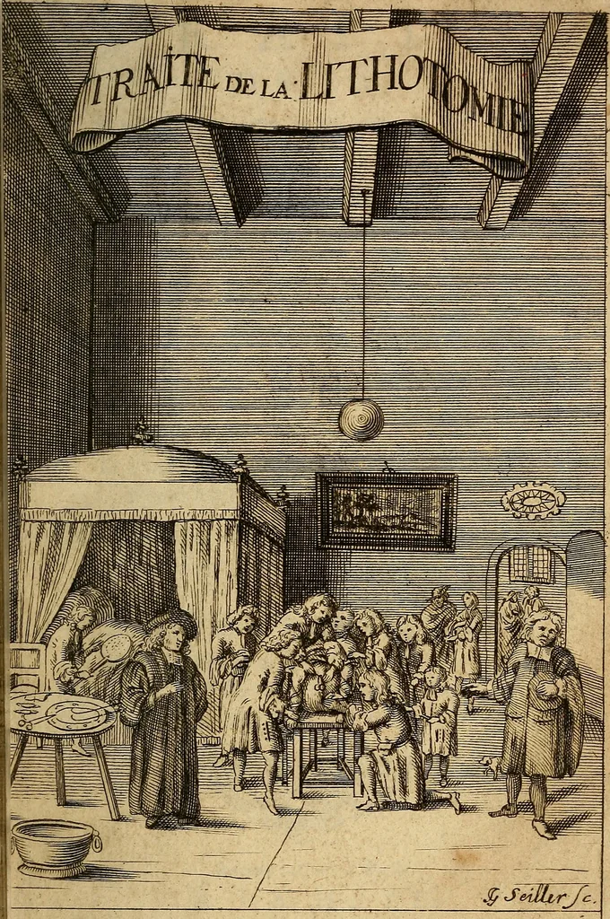 An illustration from Traite' de la lithotomie, ou, De l'extraction de la pierre, hors de la vessie : enrichy de figures necessaires pour representer la maniére de sonder, les instrumens propres, le malade dans l'operation : la ponction du perinée, & les differentes methodes de tirer la pierre : avec les appareils, les remedes preservatifs du calcul, & les medicamens pour les taillez, 1686, leaf 6