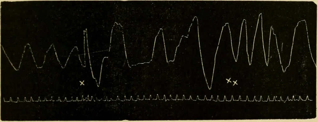 An illustration from Treatment by hypnotism and suggestion : or, psycho-therapeutics, 1900, leaf 278