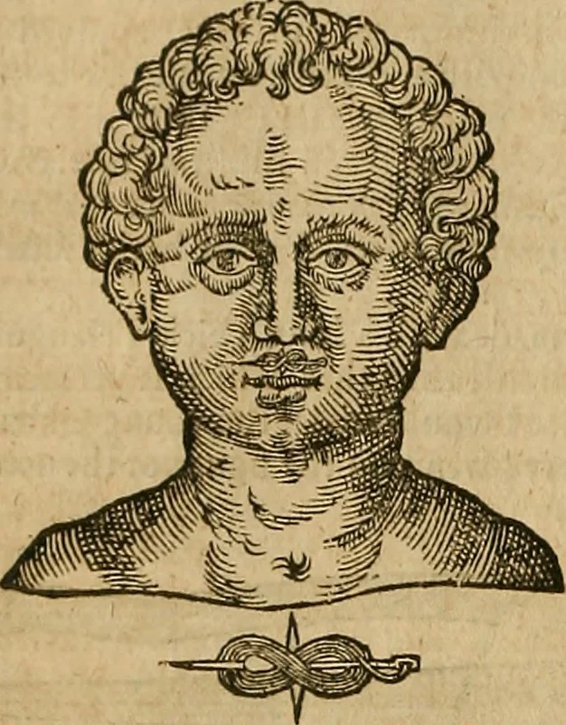 An illustration from The workes of that famous chirurgion Ambrose Parey :, 1649, leaf 319