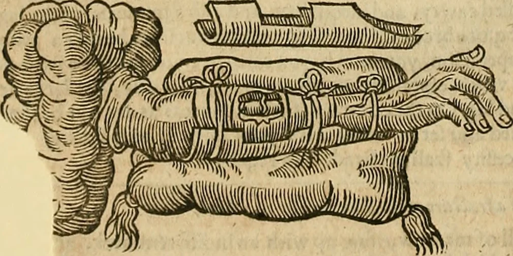 An illustration from The workes of that famous chirurgion Ambrose Parey :, 1649, leaf 395