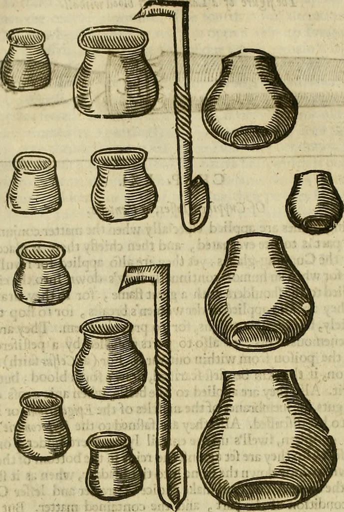 An illustration from The workes of that famous chirurgion Ambrose Parey :, 1649, leaf 479