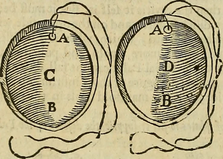 An illustration from The workes of that famous chirurgion Ambrose Parey :, 1649, leaf 615