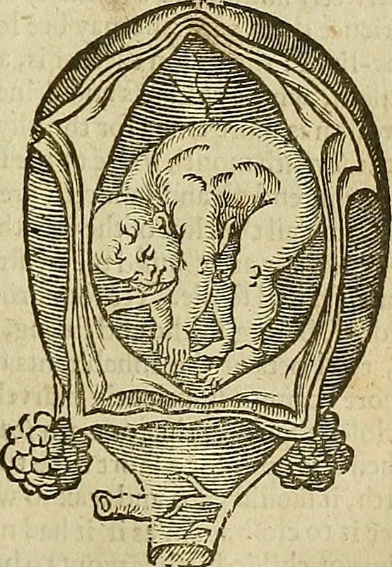An illustration from The workes of that famous chirurgion Ambrose Parey :, 1649, leaf 636