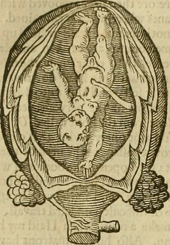 An illustration from The workes of that famous chirurgion Ambrose Parey :, 1649, leaf 637
