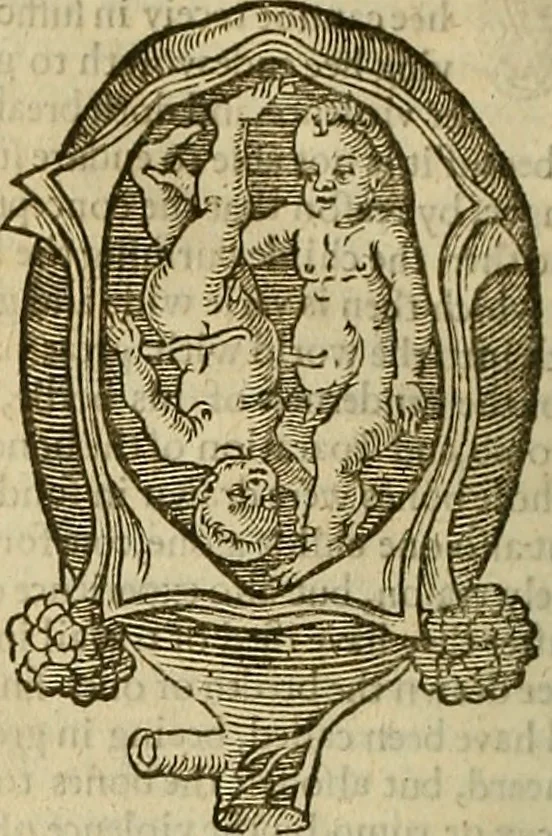 An illustration from The workes of that famous chirurgion Ambrose Parey :, 1649, leaf 637