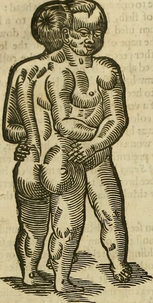An illustration from The workes of that famous chirurgion Ambrose Parey :, 1649, leaf 687