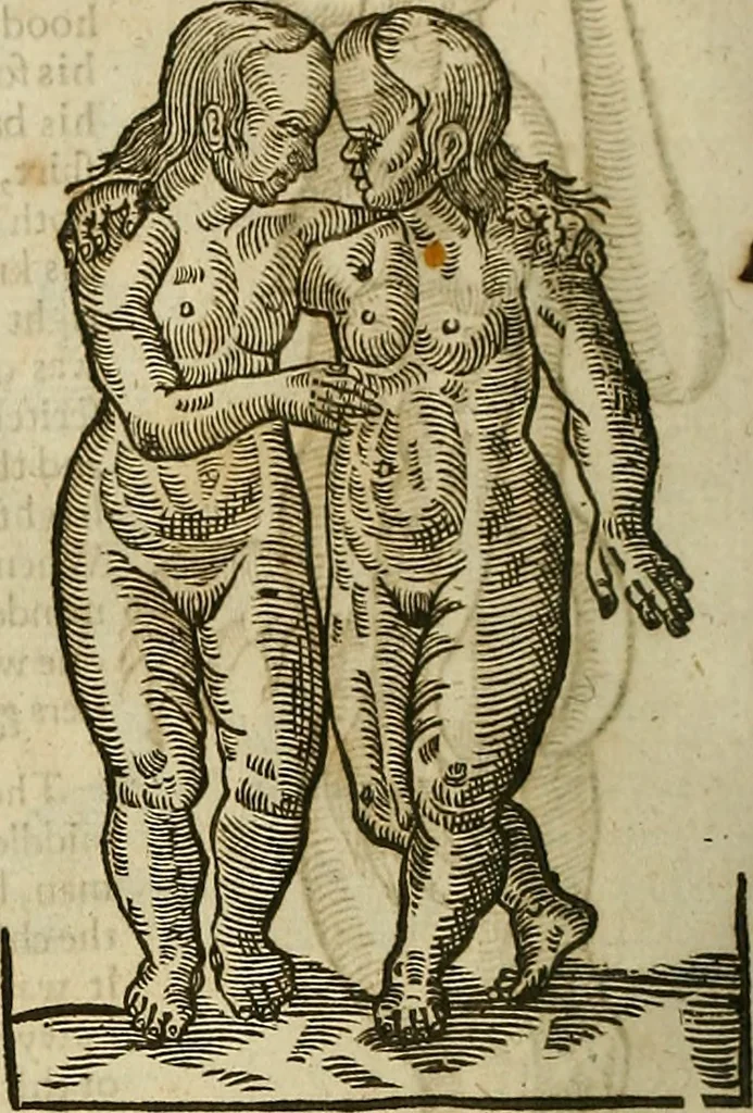 An illustration from The workes of that famous chirurgion Ambrose Parey :, 1649, leaf 687