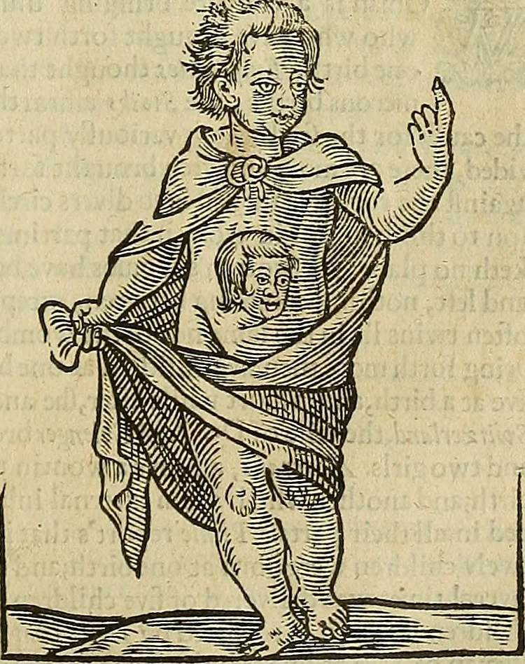An illustration from The workes of that famous chirurgion Ambrose Parey :, 1649, leaf 688