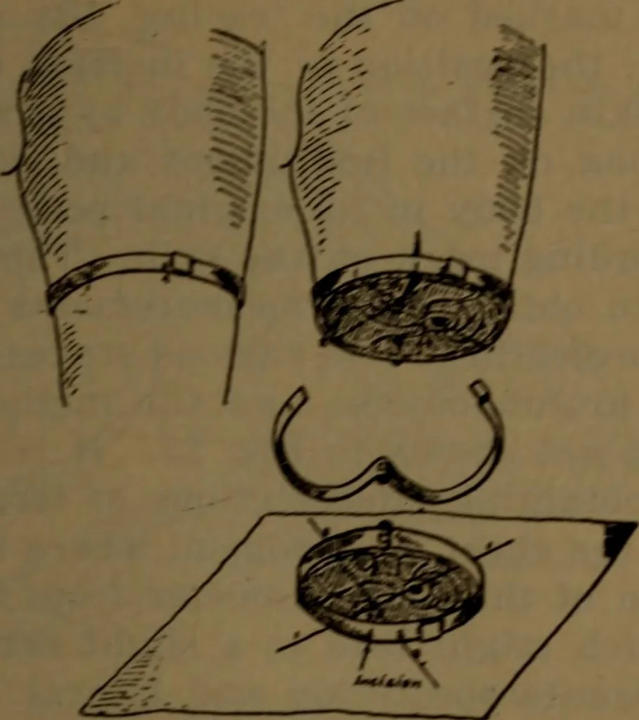 An illustration from X-ray manual : U.S. Army, 1917, leaf 178