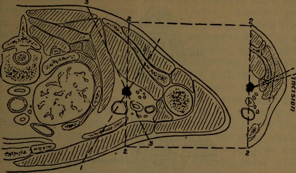 An illustration from X-ray manual : U.S. Army, 1917, leaf 180