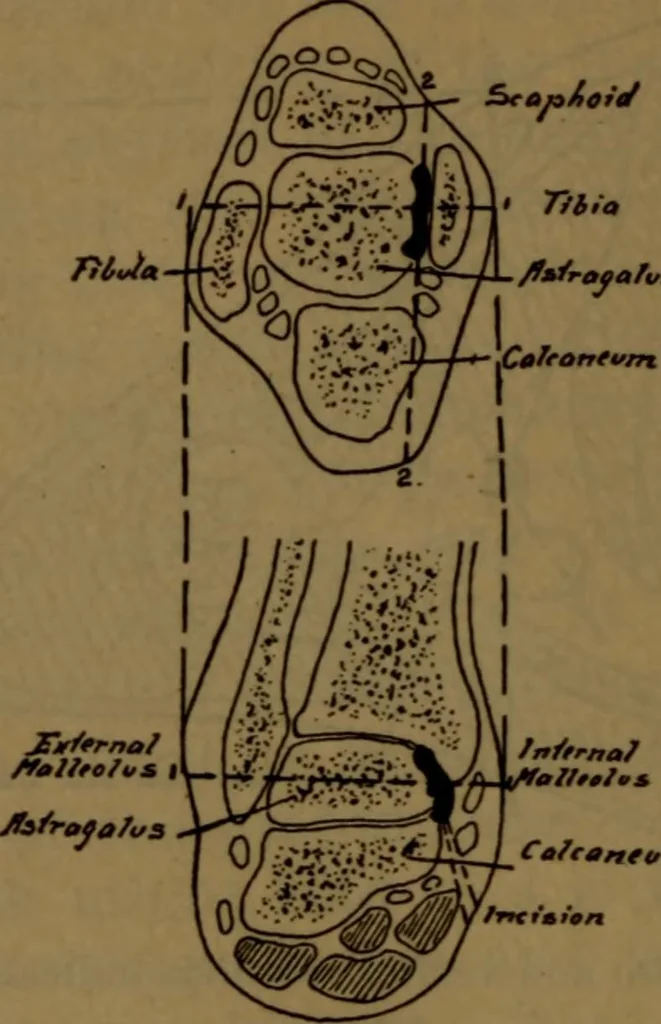An illustration from X-ray manual : U.S. Army, 1917, leaf 181