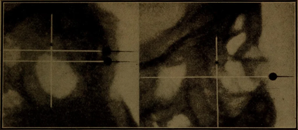 An illustration from X-ray manual : U.S. Army, 1917, leaf 210