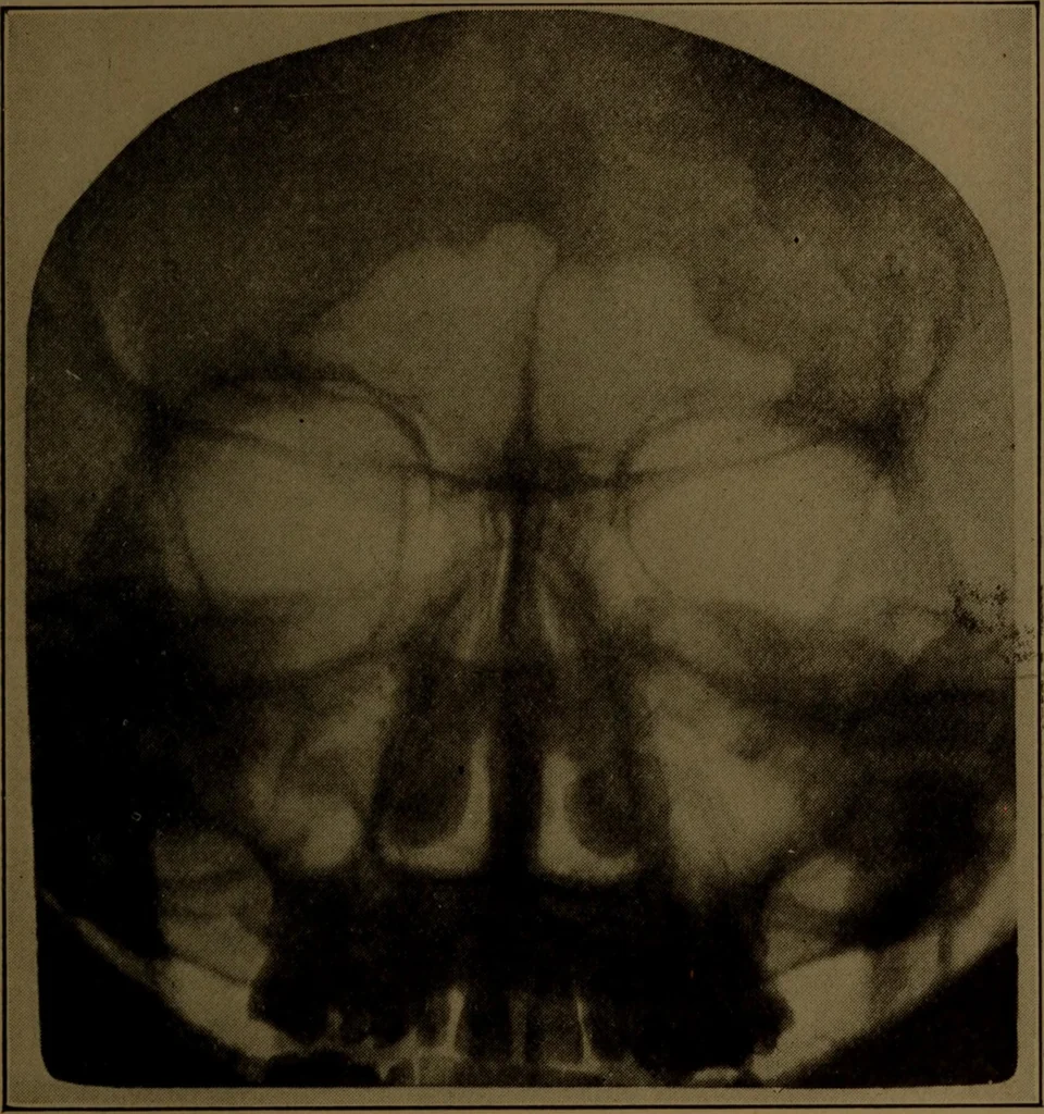 An illustration from X-ray manual : U.S. Army, 1917, leaf 222
