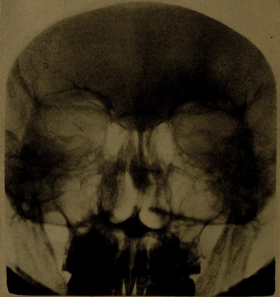 An illustration from X-ray manual : U.S. Army, 1917, leaf 223