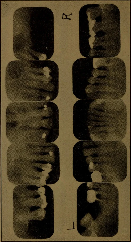 An illustration from X-ray manual : U.S. Army, 1917, leaf 233