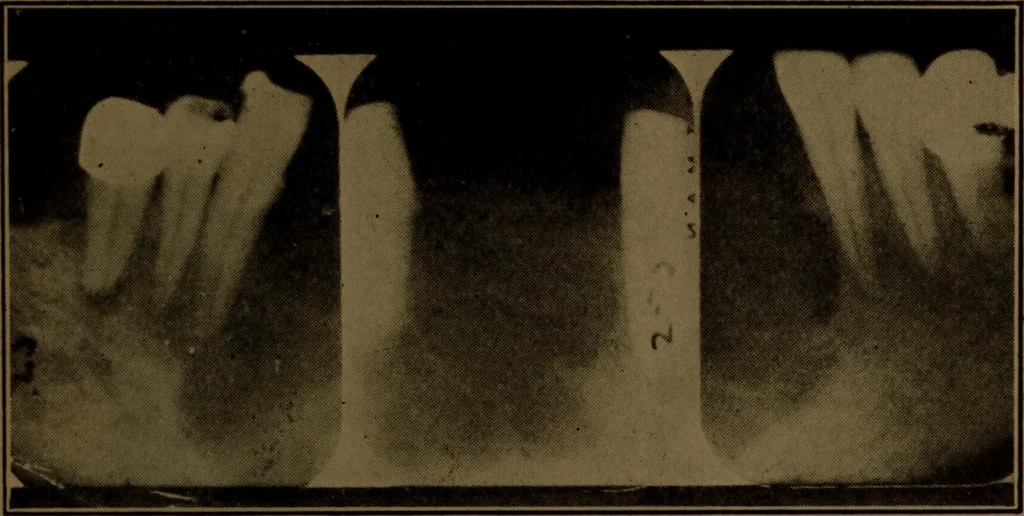 An illustration from X-ray manual : U.S. Army, 1917, leaf 234