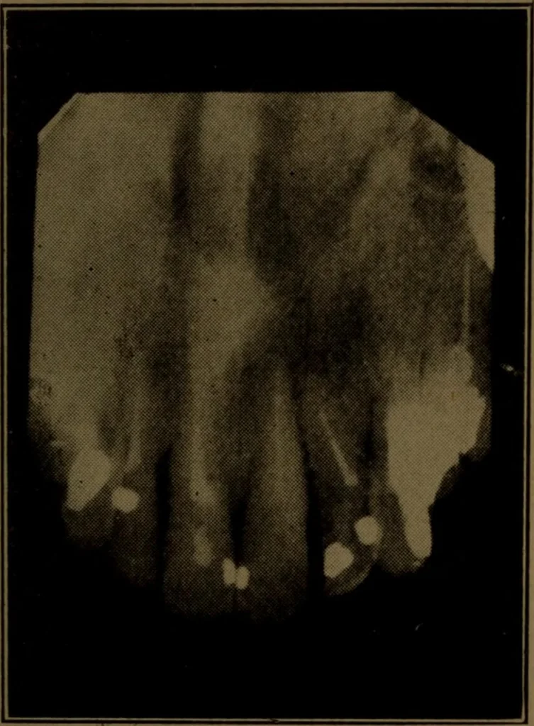 An illustration from X-ray manual : U.S. Army, 1917, leaf 234