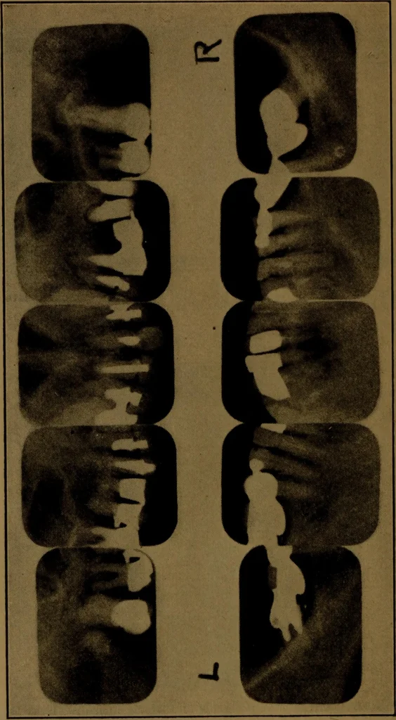 An illustration from X-ray manual : U.S. Army, 1917, leaf 235