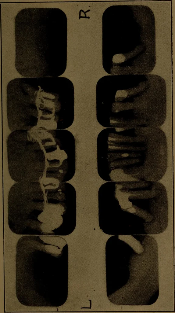 An illustration from X-ray manual : U.S. Army, 1917, leaf 236