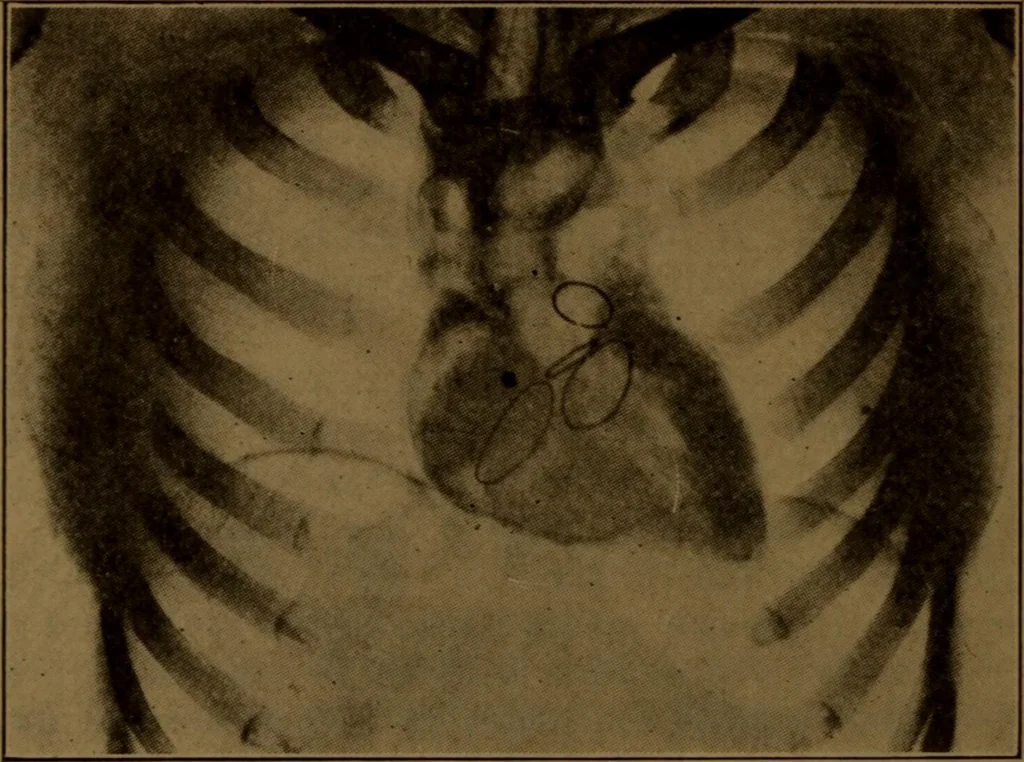 An illustration from X-ray manual : U.S. Army, 1917, leaf 253