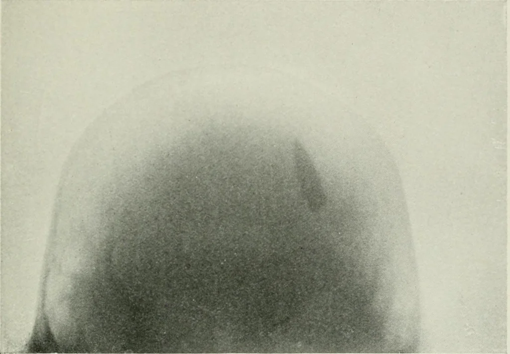 An illustration from X-rays, how to produce and interpret them, 1915, leaf 104