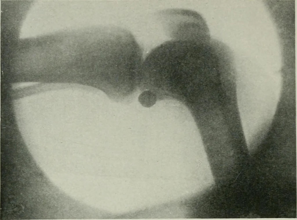 An illustration from X-rays, how to produce and interpret them, 1915, leaf 105