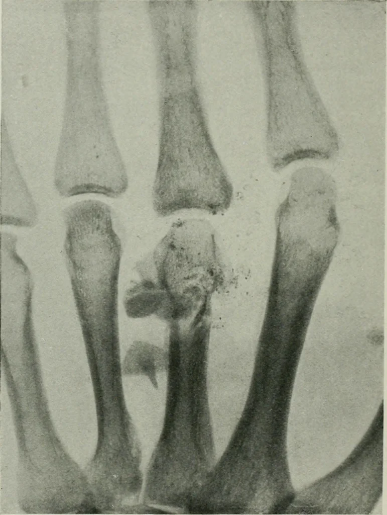 An illustration from X-rays, how to produce and interpret them, 1915, leaf 107