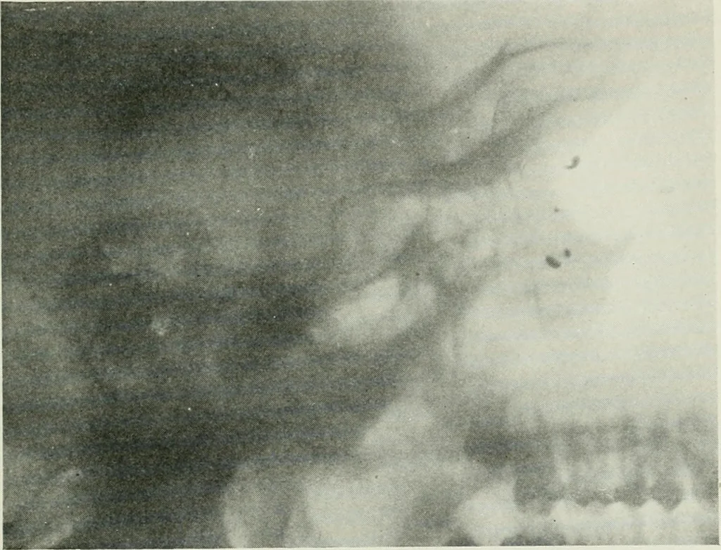 An illustration from X-rays, how to produce and interpret them, 1915, leaf 110