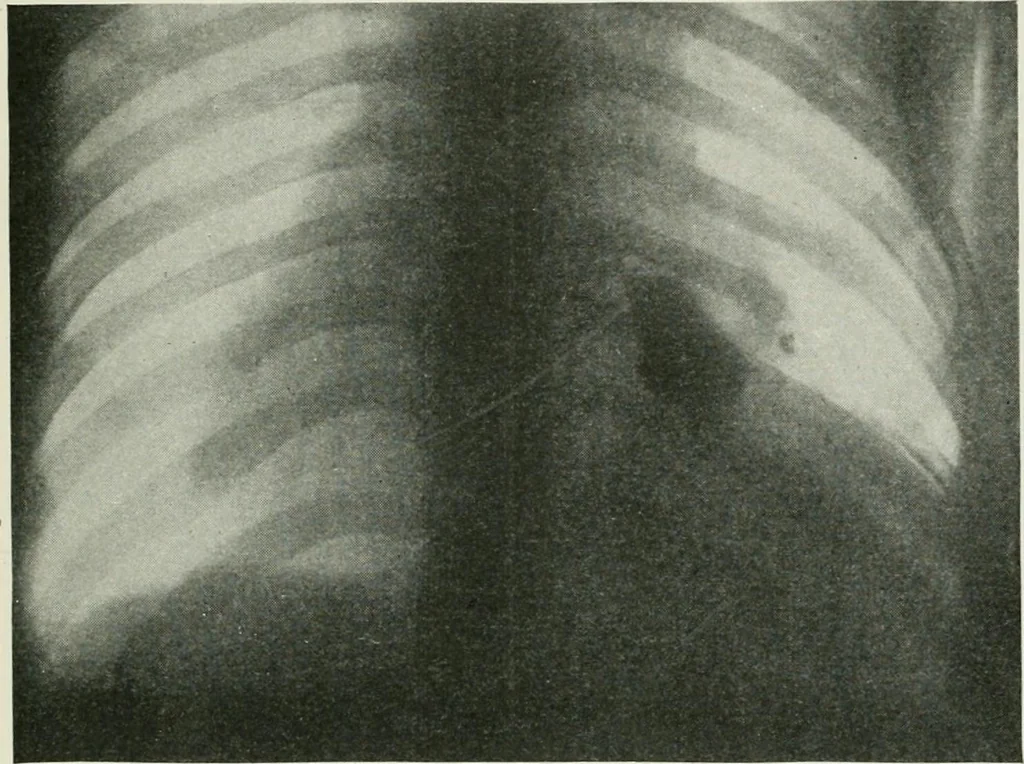 An illustration from X-rays, how to produce and interpret them, 1915, leaf 126