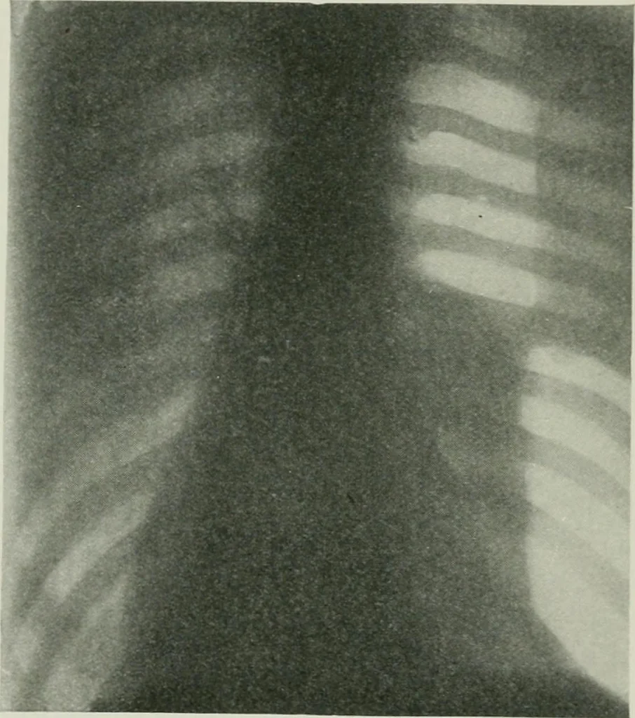 An illustration from X-rays, how to produce and interpret them, 1915, leaf 127