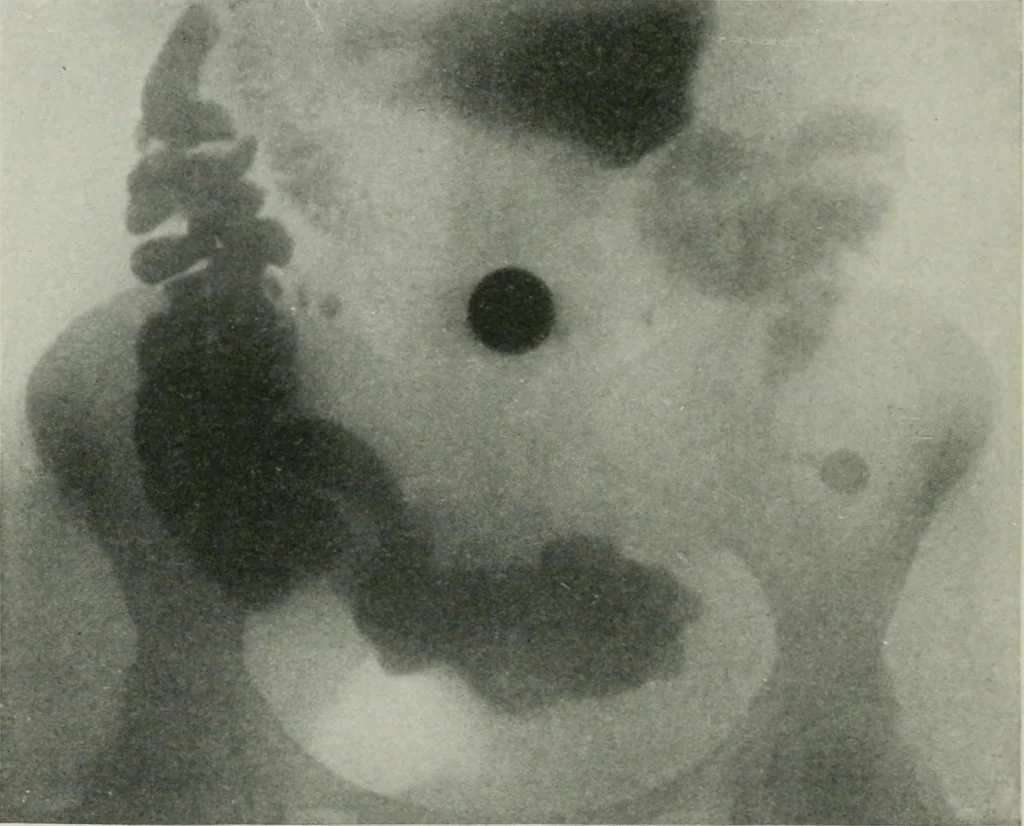 An illustration from X-rays, how to produce and interpret them, 1915, leaf 137
